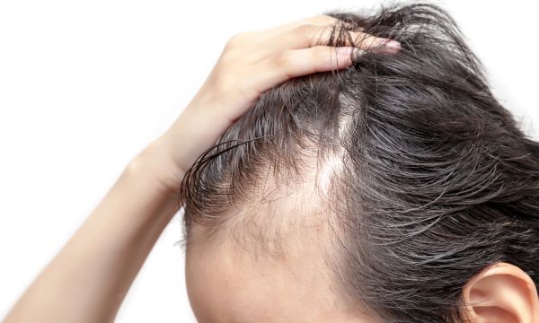 Todo lo que necesitas saber sobre la Alopecia en Hombres